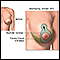 Elevación de mamas (mastopexia) - serie - Incisión