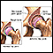 Arthritis in hip