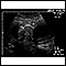 Ultrasonido de un feto normal - medidas del abdomen
