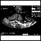 Ultrasound, normal placenta - Braxton Hicks