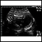 Ultrasound, normal fetus - femur measurement