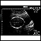 Ultrasonido de un feto normal - medidas de la cabeza