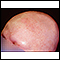Alopecia total - vista frontal de la cabeza