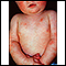 Dermatitis - atópica en un bebé