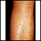 Folliculitis on the leg