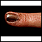 Skin cancer, melanoma on the fingernail