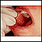 Liquen plano en la mucosa oral
