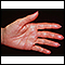 Herpes zoster (culebrilla) en la mano