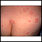 Hives (urticaria) on the back and buttocks