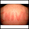 Dermatografismo de la espalda