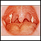 Mononucleosis - vista de la garganta