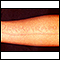 Dermatografismo del brazo