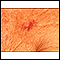 Vista de cerca de un carcinoma de célula basal