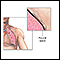 Chest tube insertion - series - Pleural cavity