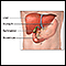 Gallbladder removal - Series