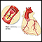 Enfermedad de las arterias coronarias