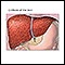 Cirrosis del hígado