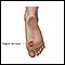 El sarcoma de Kaposi en el pie