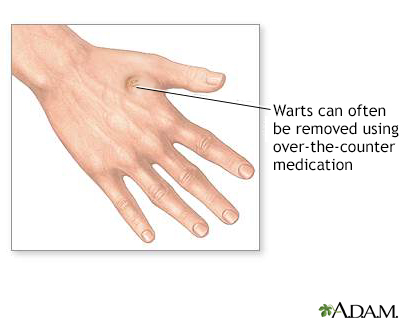Wart removal
