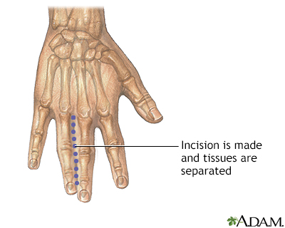 Incision