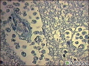 Amebic brain abscess