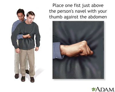 Heimlich maneuver on adult