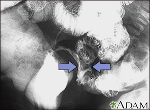 Crohn disease - X-ray