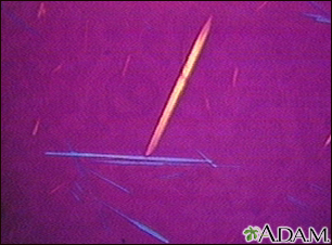 Uric acid crystals