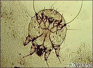 Scabies mite - photomicrograph