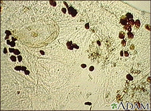 Scabies mite - photomicrograph of the stool