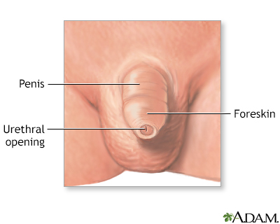 Hypospadias repair - series