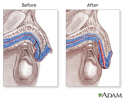 Hypospadias - Aftercare