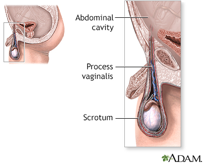 Hydrocele repair - series