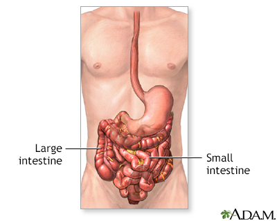 Intestinal obstruction repair - series