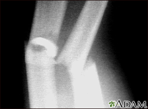 Fracture, forearm - X-ray