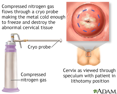 Cervical cryosurgery