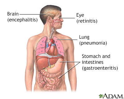 CMV (cytomegalovirus)