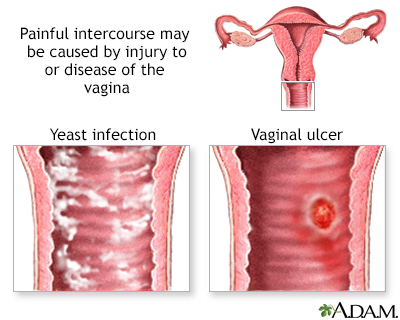 Causes of painful intercourse