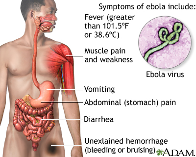 Ebola virus disease