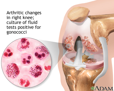 Gonoccocal arthritis