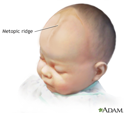 Metopic ridge