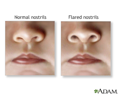 Nasal flaring