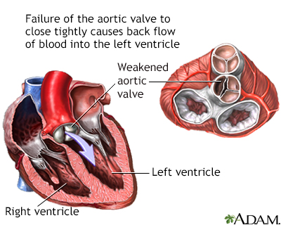 Aortic insufficiency