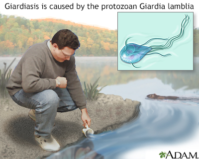 Giardiasis