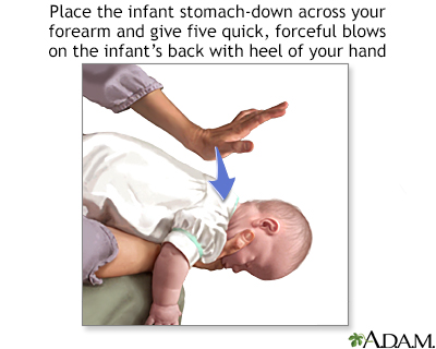 Heimlich maneuver on infant