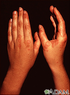 Erythema multiforme, circular lesions - hands