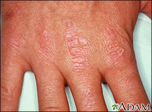 Dermatomyositis - Gottron's papules on the hand