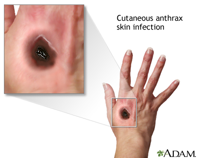 Cutaneous Anthrax