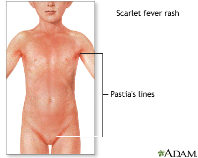 Signs of scarlet fever