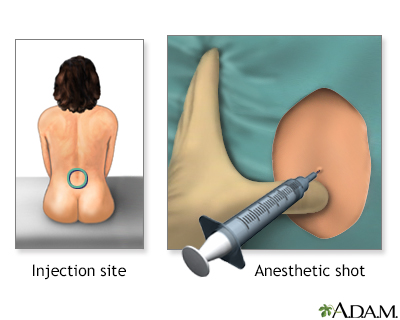 Procedure - Epidural 3